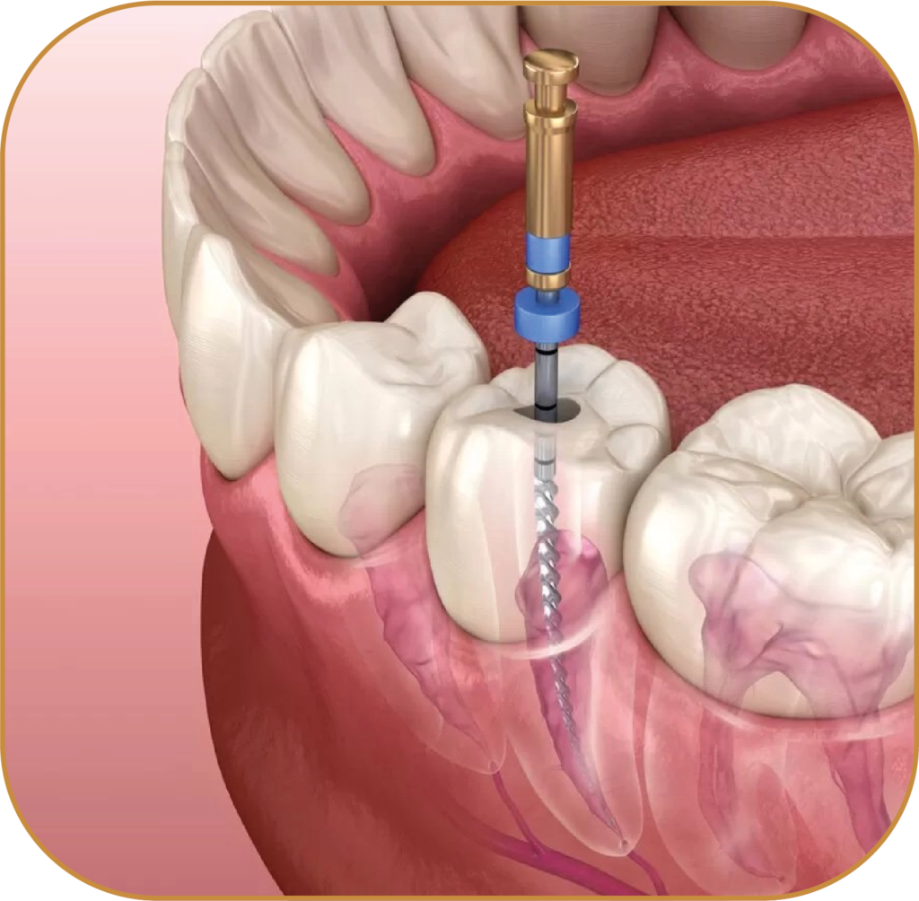 ENDODONCIA