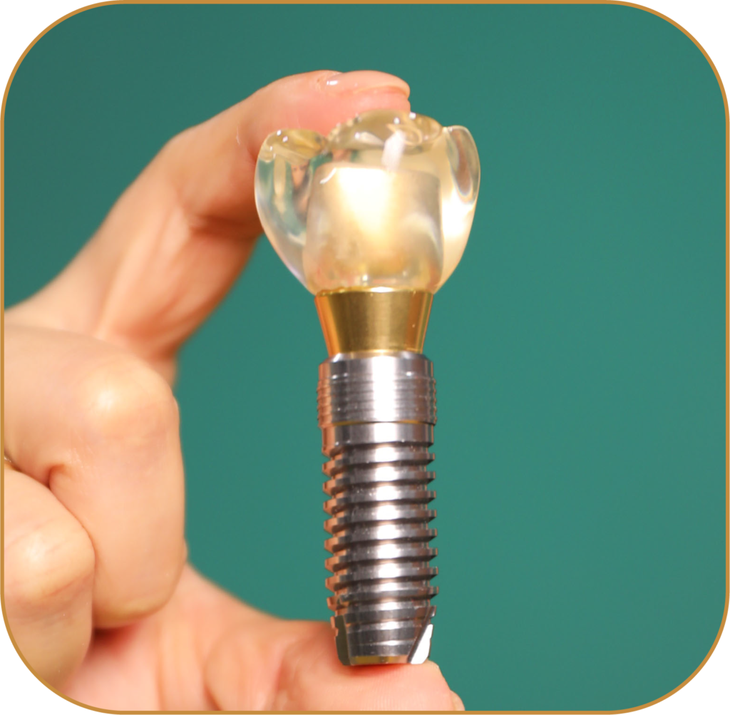 IMPLANTES DENTALES