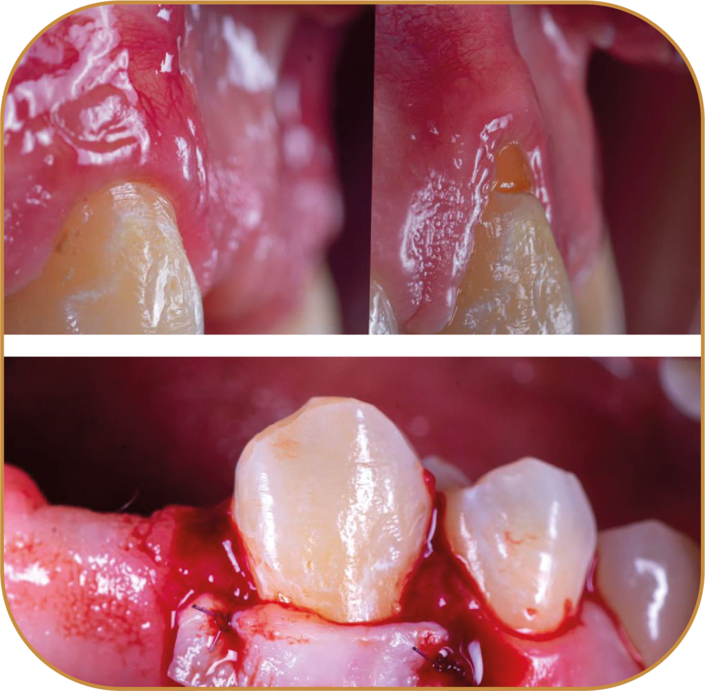PERIODONCIA